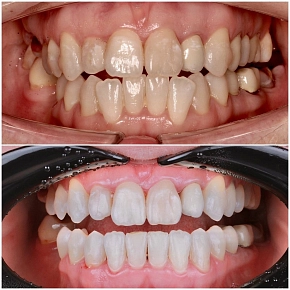 Ортодонтическая коррекция прикуса с помощью элайнеров