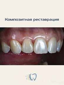 Композитная реставрация