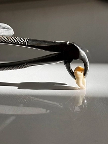 Можно ли удалить все зубы мудрости одновременно?