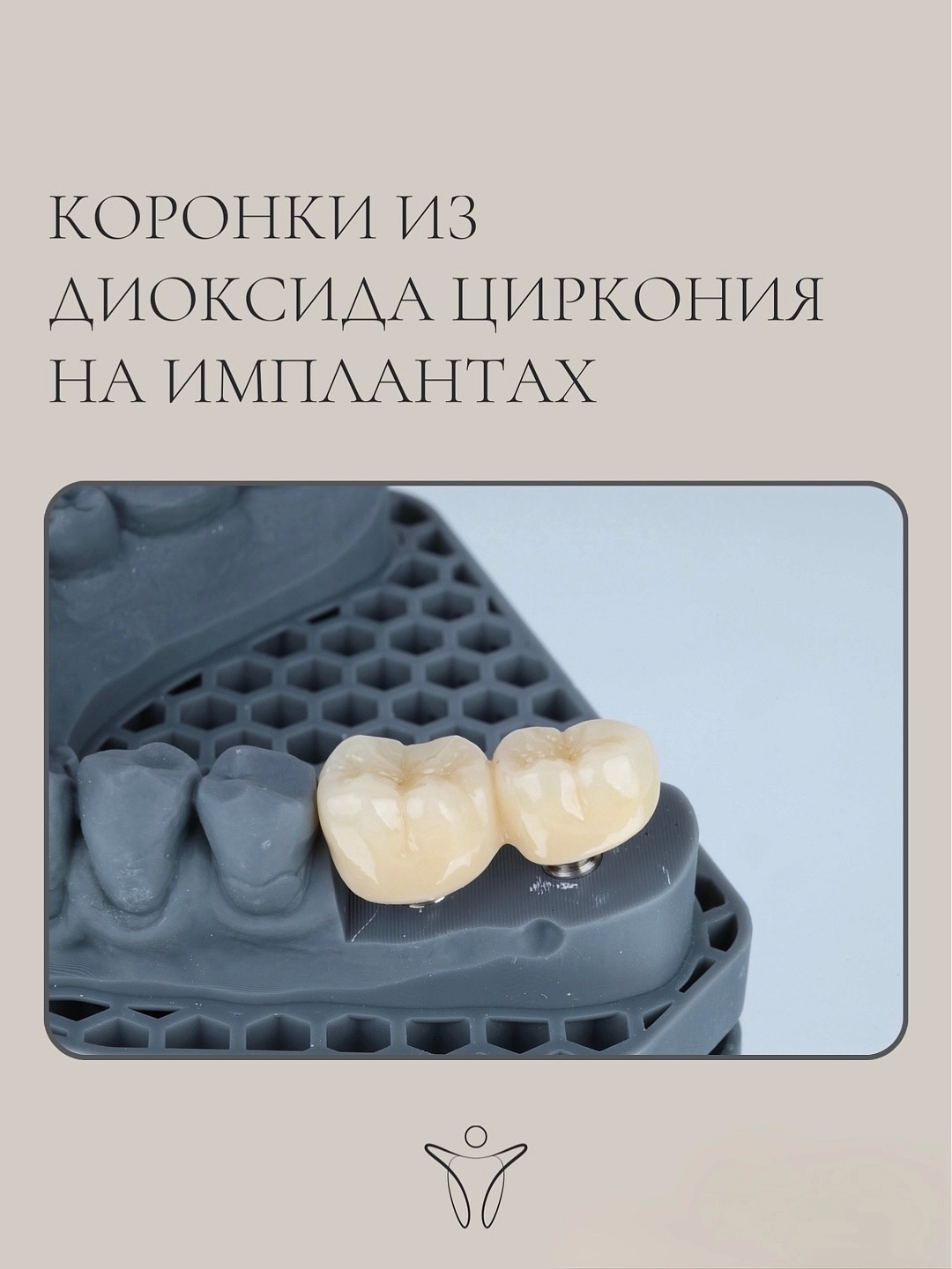 Восстановление зубов на имплантах