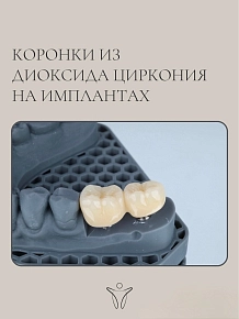 Восстановление зубов на имплантах