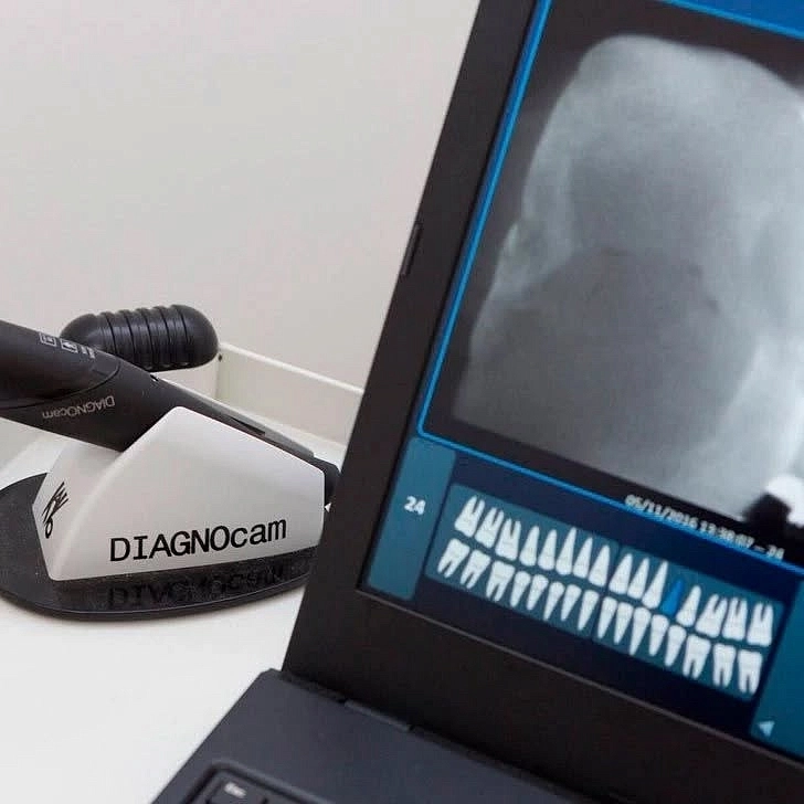 Как распознать скрытый кариозный процесс