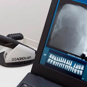 Как распознать скрытый кариозный процесс