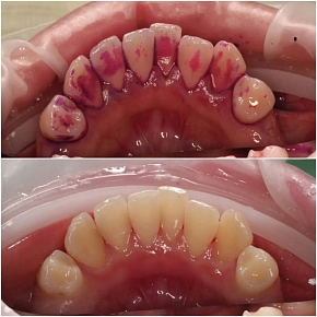 Профессиональная гигиена зубов