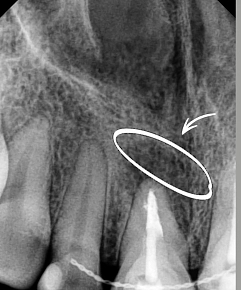 Болезненные ощущения в зубе при нажатии