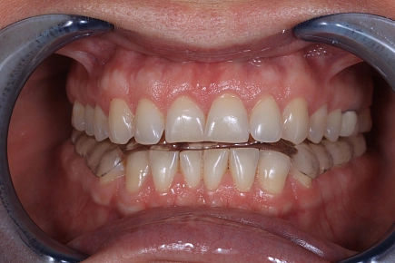 Компрессия в височно-нижнечелюстном суставе