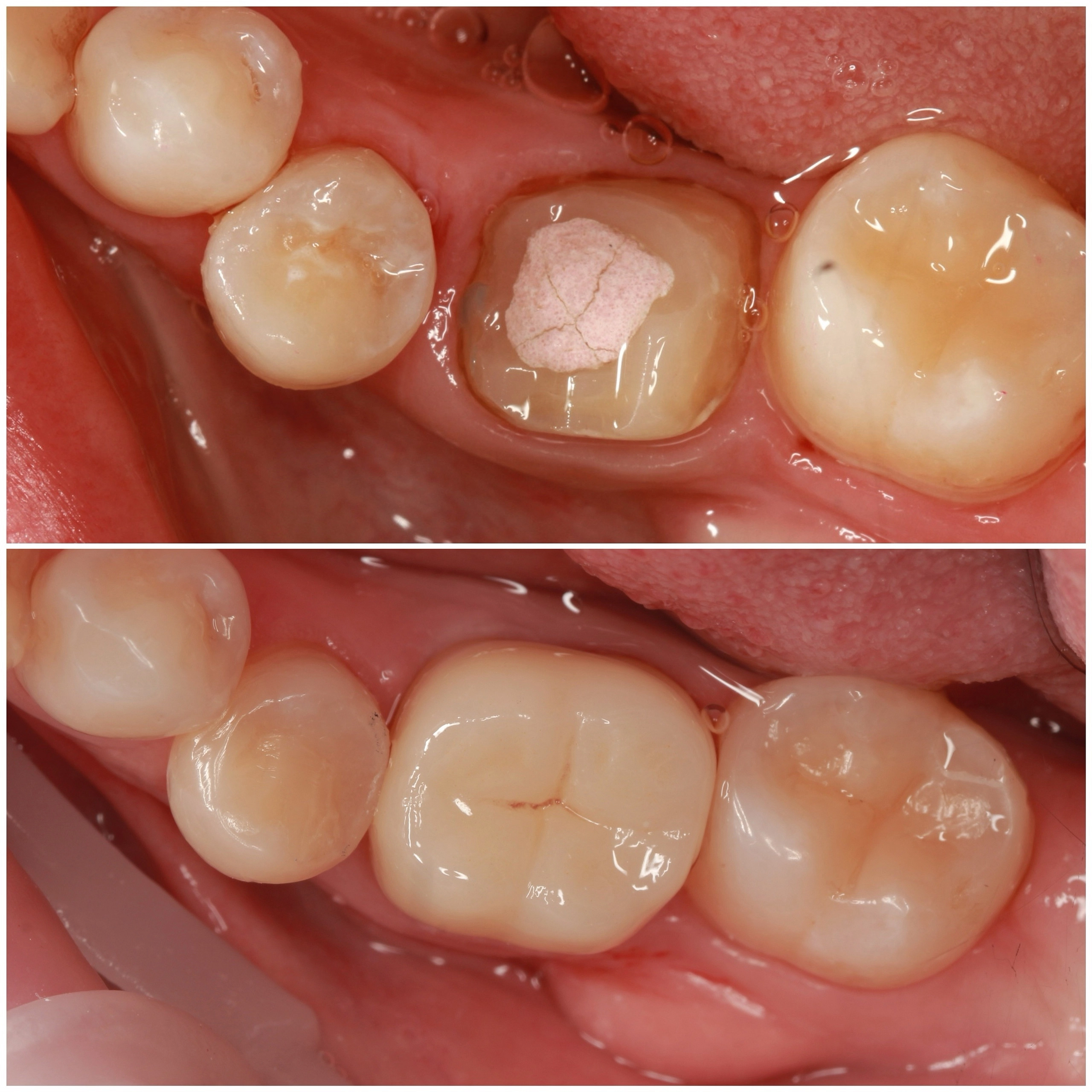 Укрепление зубов без нервов с помощью коронки