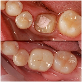 Укрепление зубов без нервов с помощью коронки