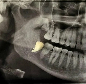 Зубы мудрости, незаметная угроза