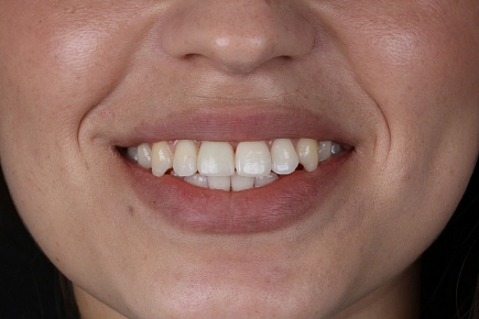 Когда устанавливать имплант после удаления зуба