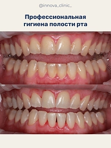 Регулярная профессиональная гигиена помогает поддерживать не только чистоту зубов, но и здоровье дёсен