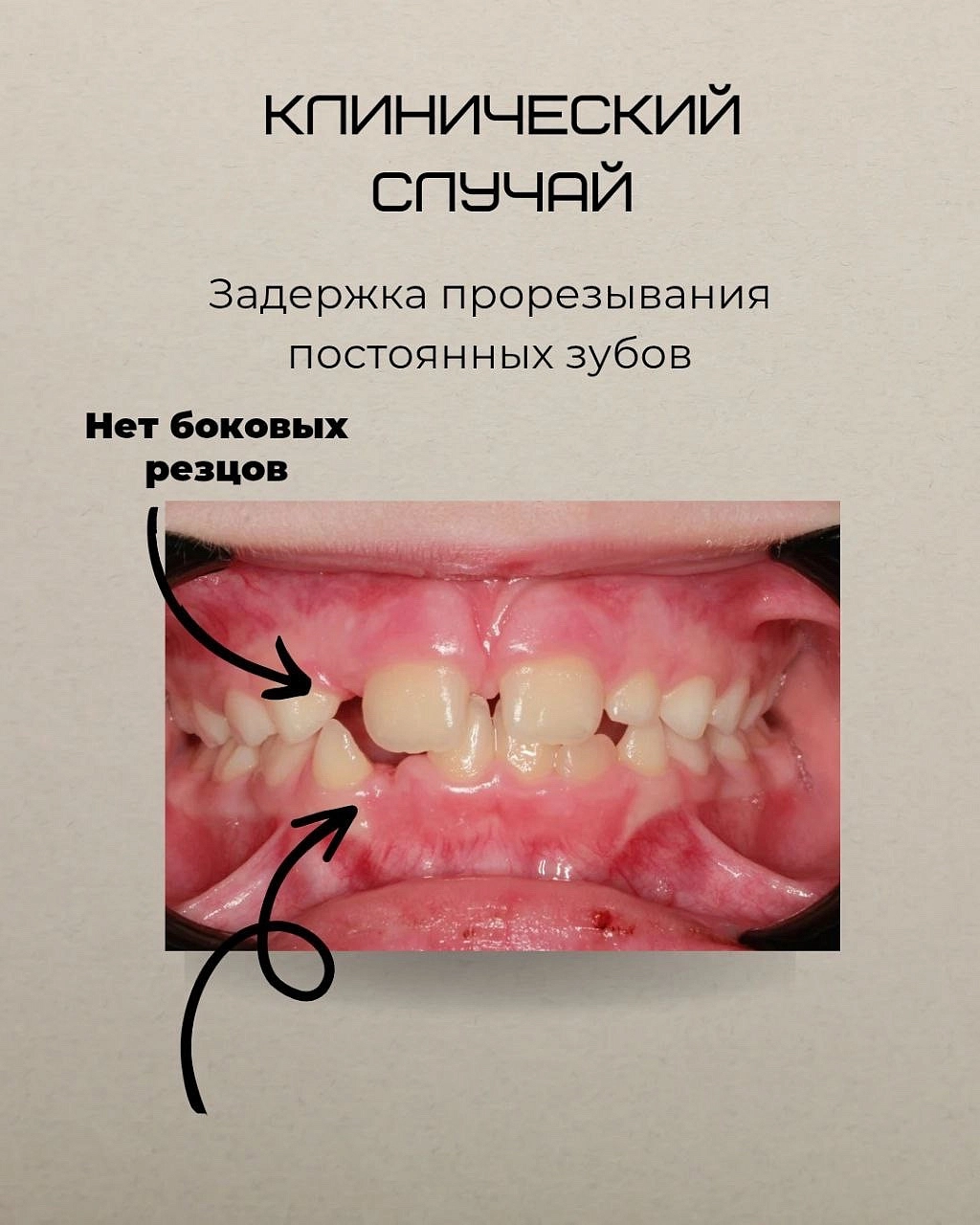 Задержка прорезывания постоянных зубов