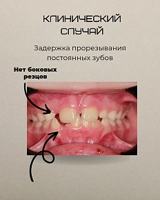 Задержка прорезывания постоянных зубов