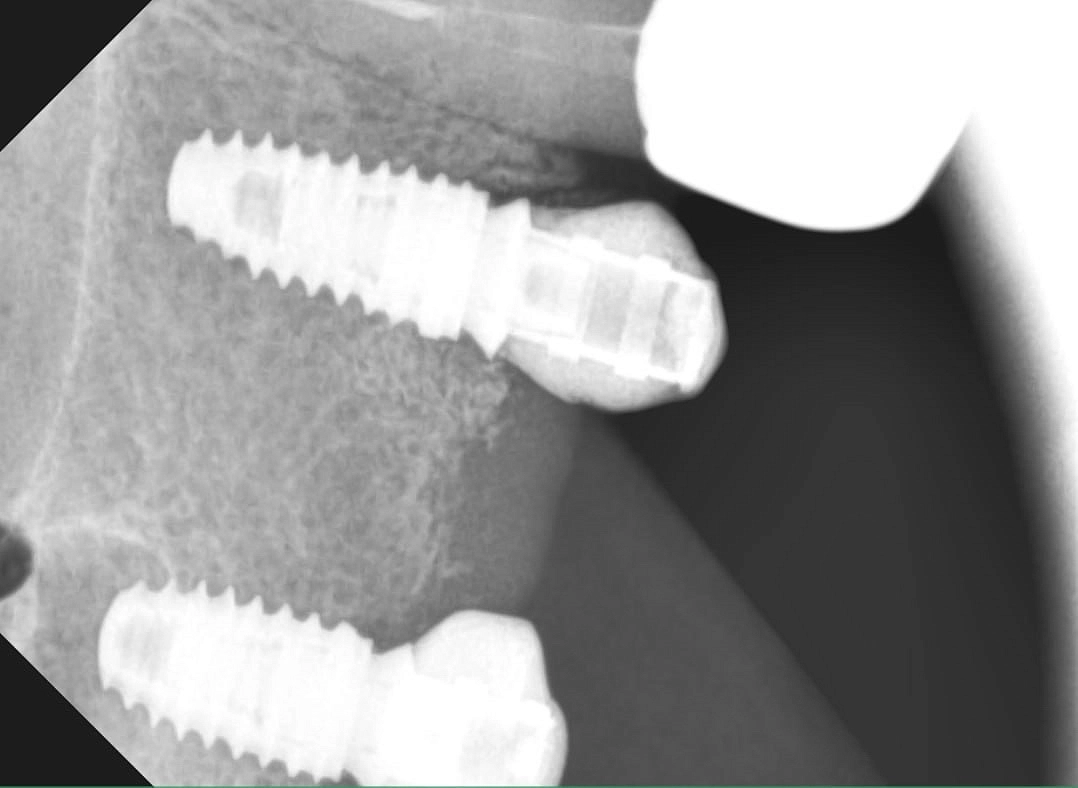 Угол наклона импланта при установке критически важен