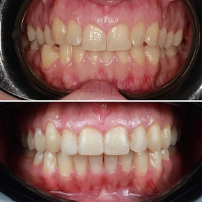 Успешное ортодонтическое лечение