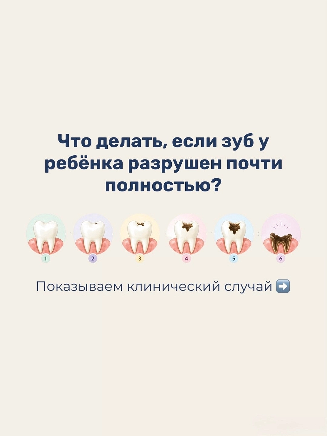 Что делать если зуб у ребенка разрушен почти полностью?