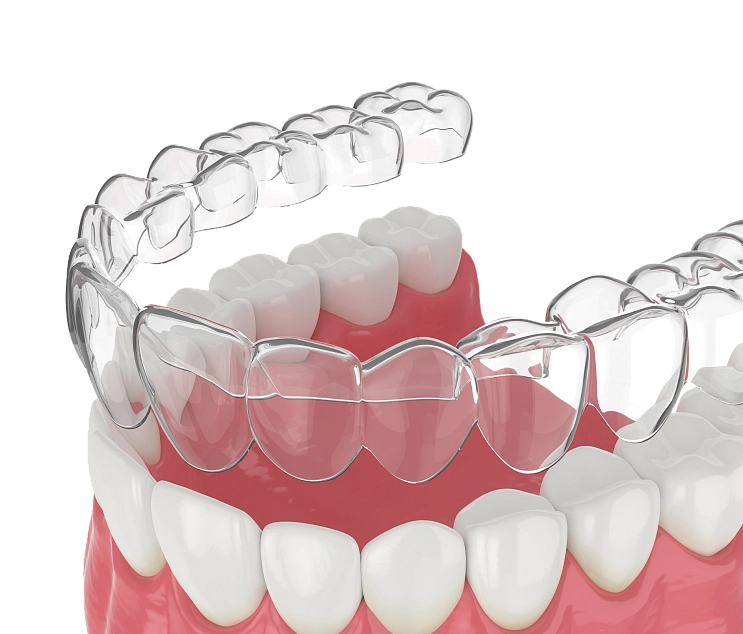 Установка элайнеров фото