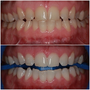 Вызывает ли отбеливание зубов чувствительность ?