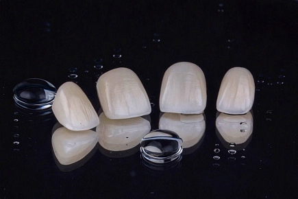 Нужно ли исправлять прикус перед установкой виниров?