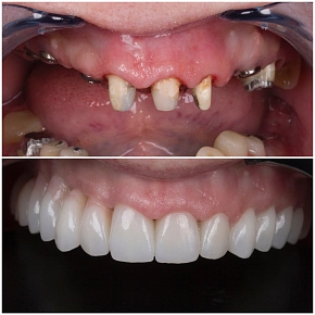 Тотальная реабилитация зубов