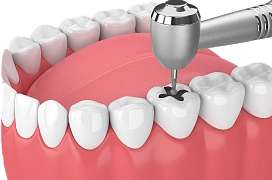 Лечение зубов фото