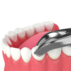 Удаление молочных зубов фото