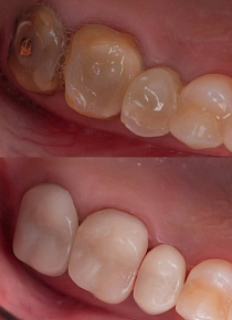 Установка временных коронок на длительный срок