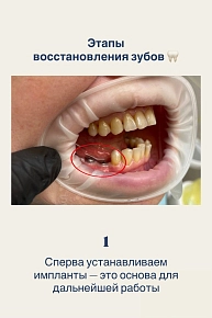 Имплантация — это поэтапная работа