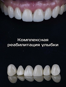 Комплексная реабилитация улыбки