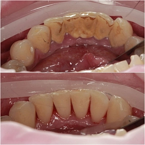 Зубной камень и как с ним бороться?