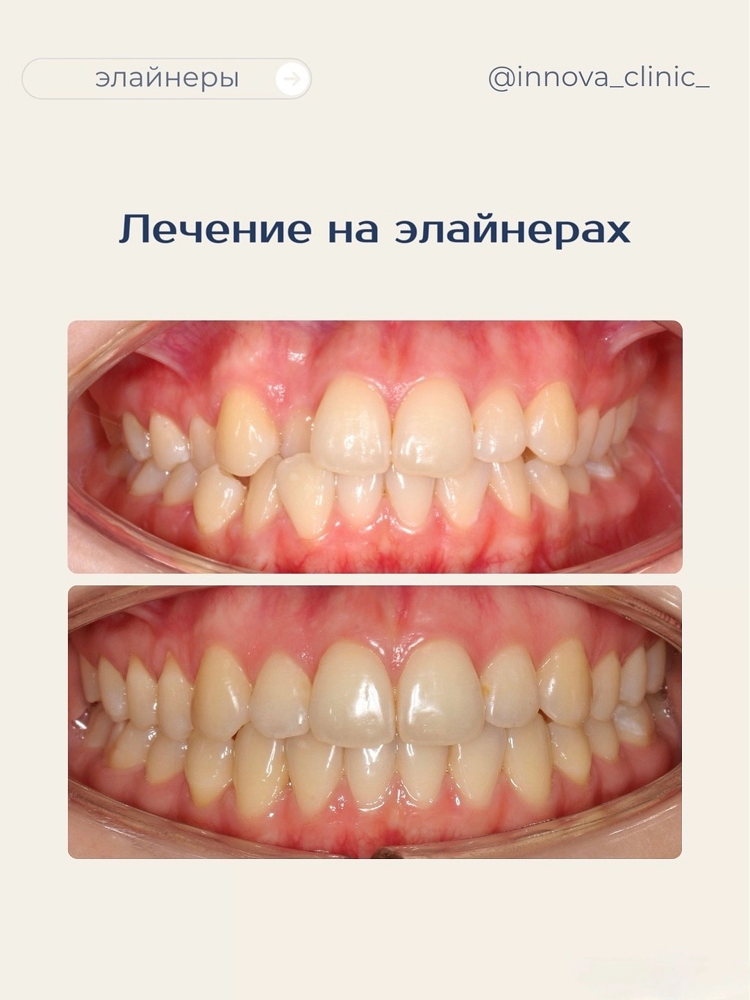 Результат лечения на элайнерах