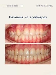 Результат лечения на элайнерах