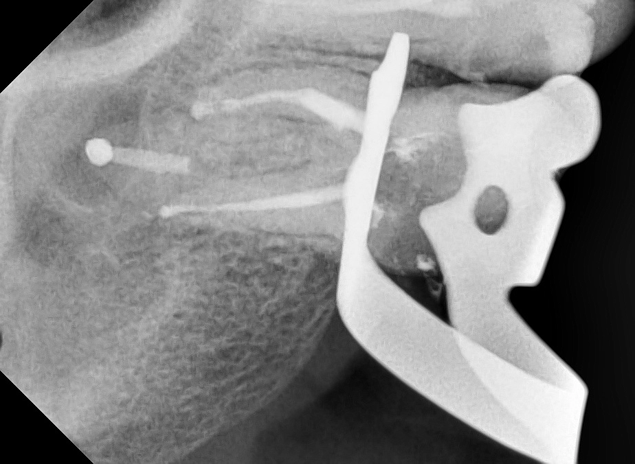 Нужно ли извлекать сломанный инструмент в корневом канале?