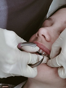 Этапы и сроки лечения брекетами