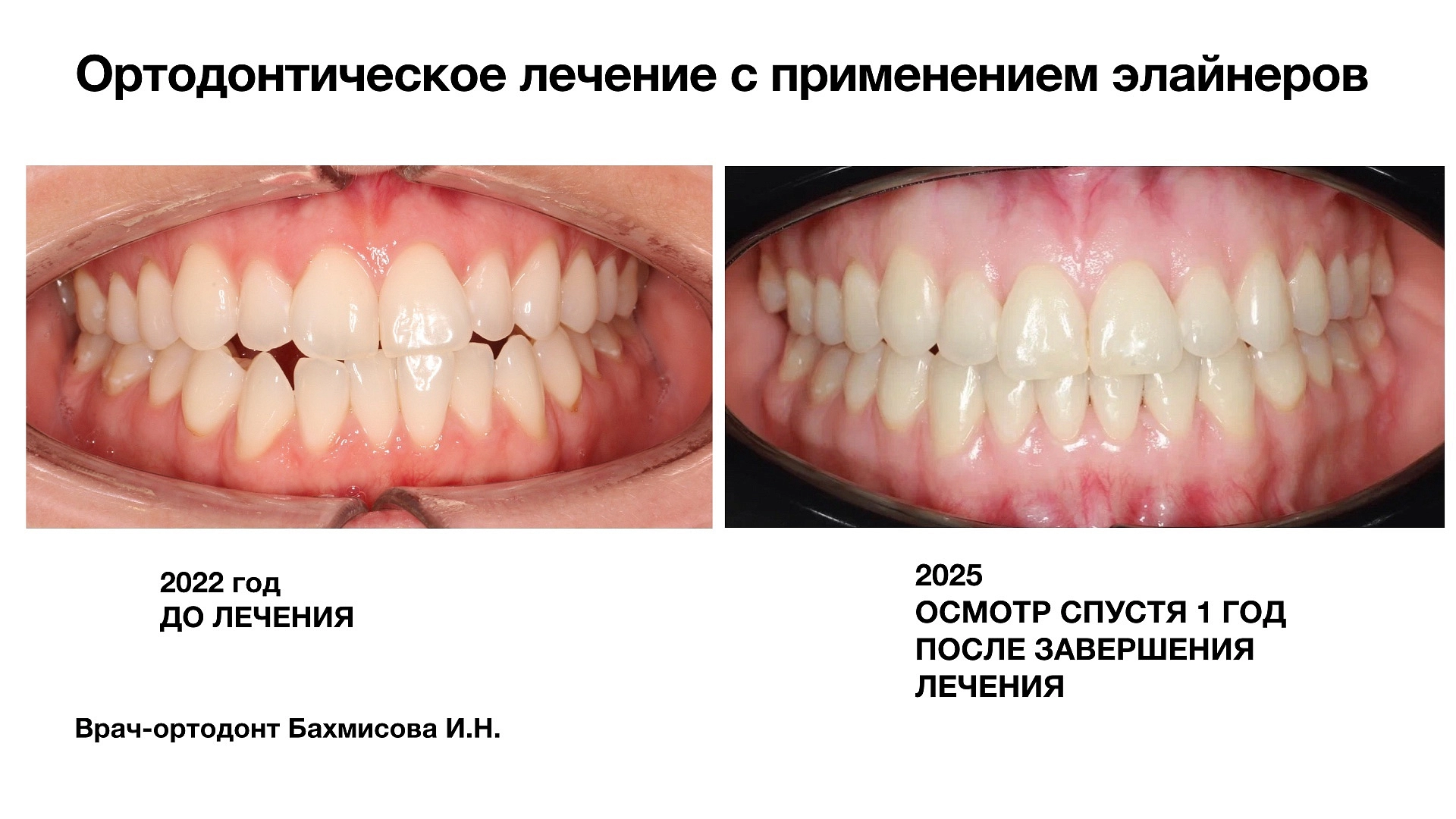 Лечение на элайнерах