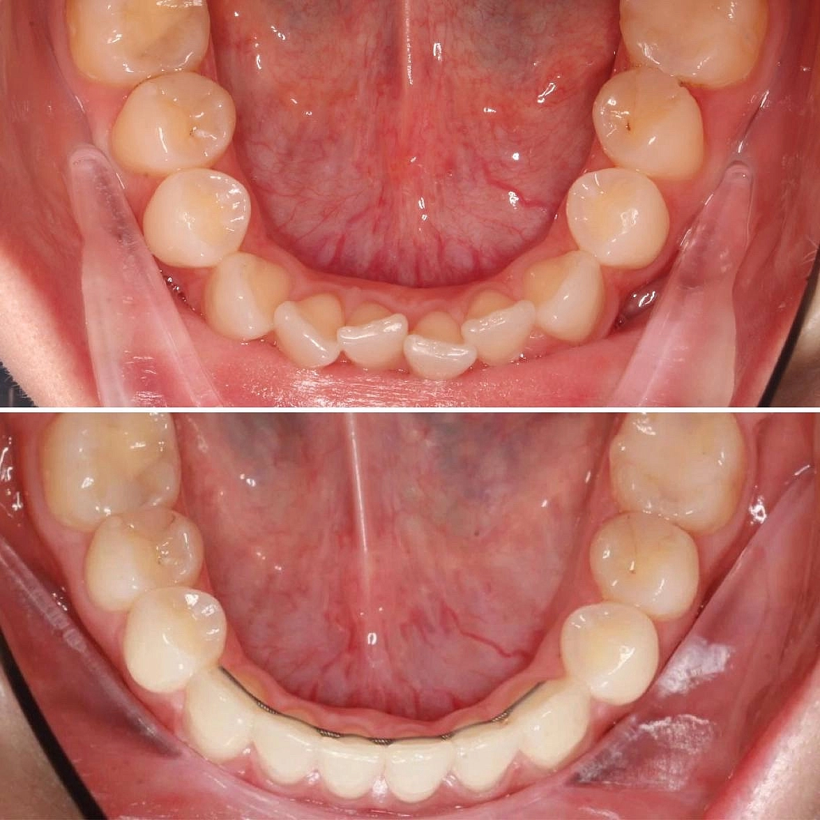 Скученность зубов