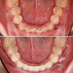 Скученность зубов