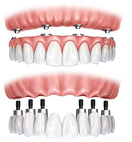 Имплантация All-on-4 vs. All-on-6