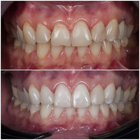 Отбеливание зубов в сочетании с композитной реставрацией