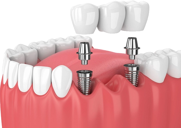 Имплантация фото