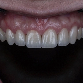 Установка виниров