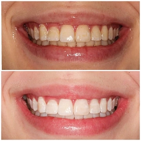 Почему мы выбираем систему Philips Zoom White Speed