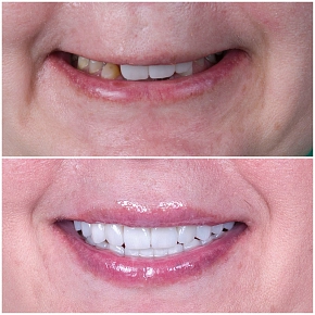 Антивозрастная стоматология