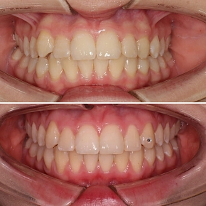 Когда нужно удаление зуба при ортодонтическом лечении?