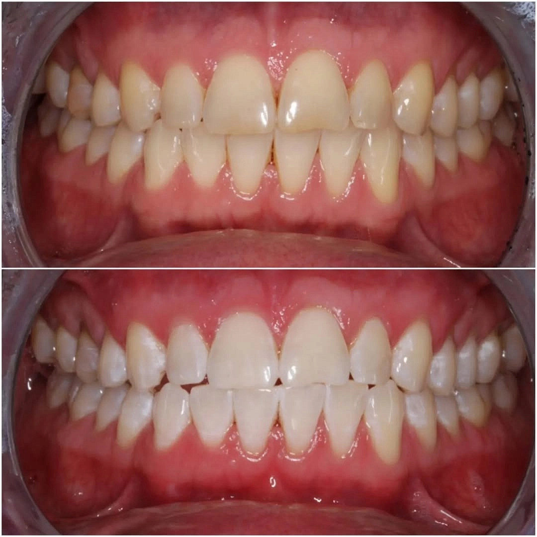 Отбеливание зубов с помощью Philips Zoom White Speed