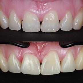 Закрытие промежутков между зубами