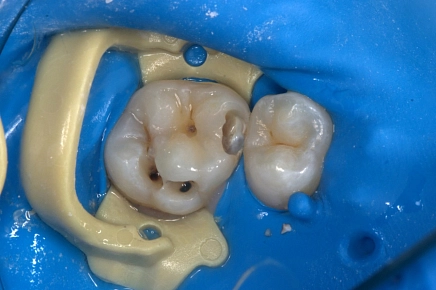 Бережное отношение к тканям зуба во время лечения крайне важно