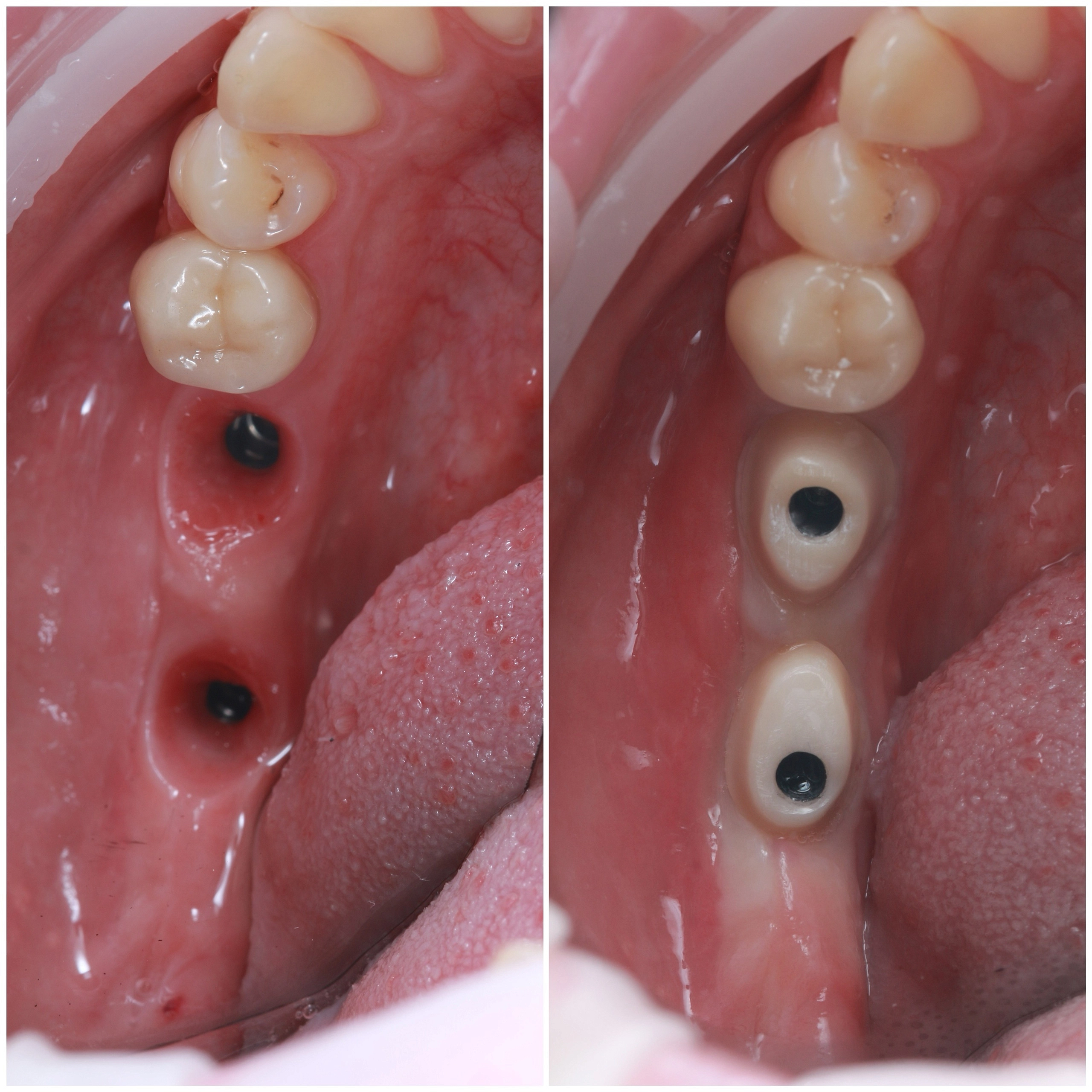 Коронка на импланте: какие виды бывают и как выбрать?