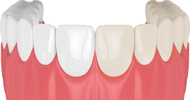 Профессиональное отбеливание фото