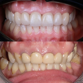 Негерметичность старых коронок: время обновления!